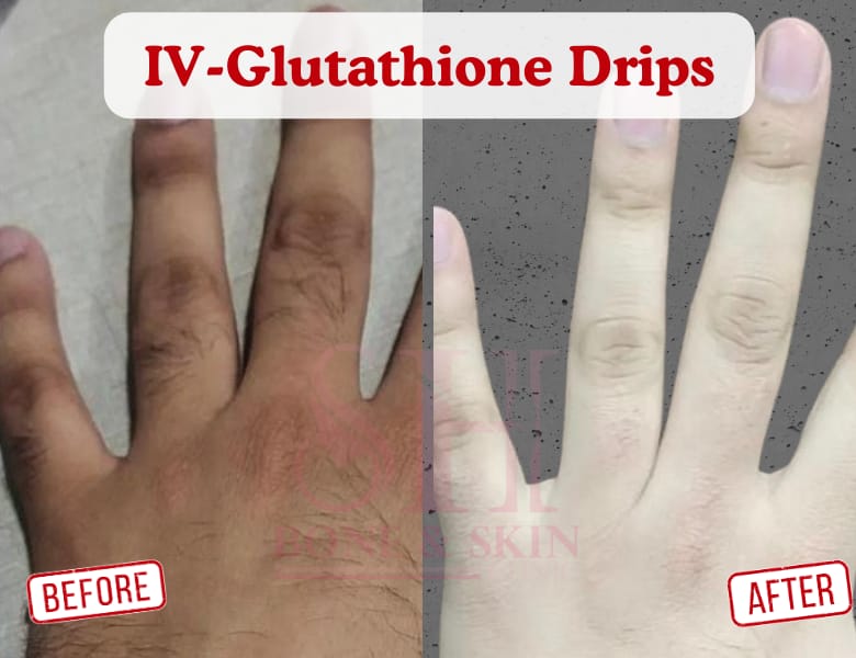 Glutathione Treatment Before & After
